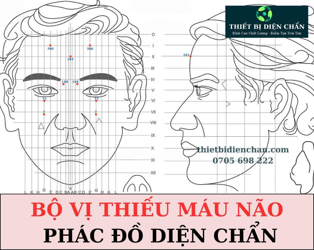 Thiếu máu não