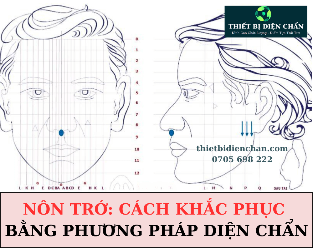 Nôn trớ