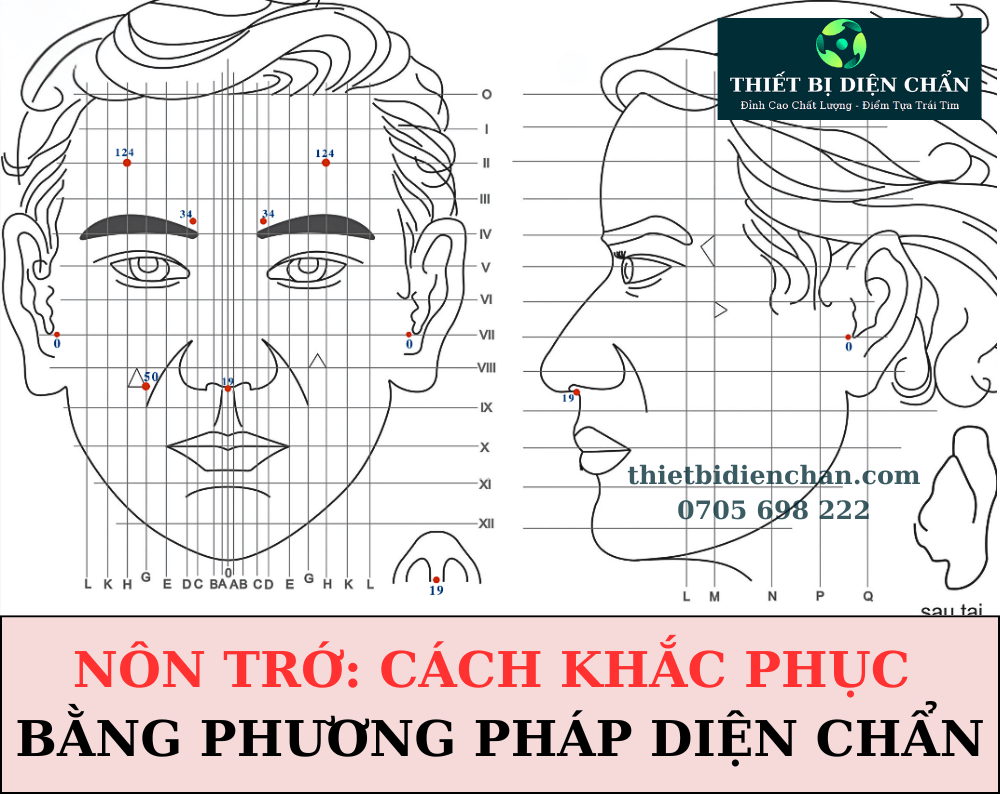 Nôn trớ