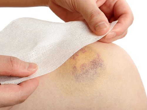 Xử lý sưng bầm bằng phương pháp Diện Chẩn
