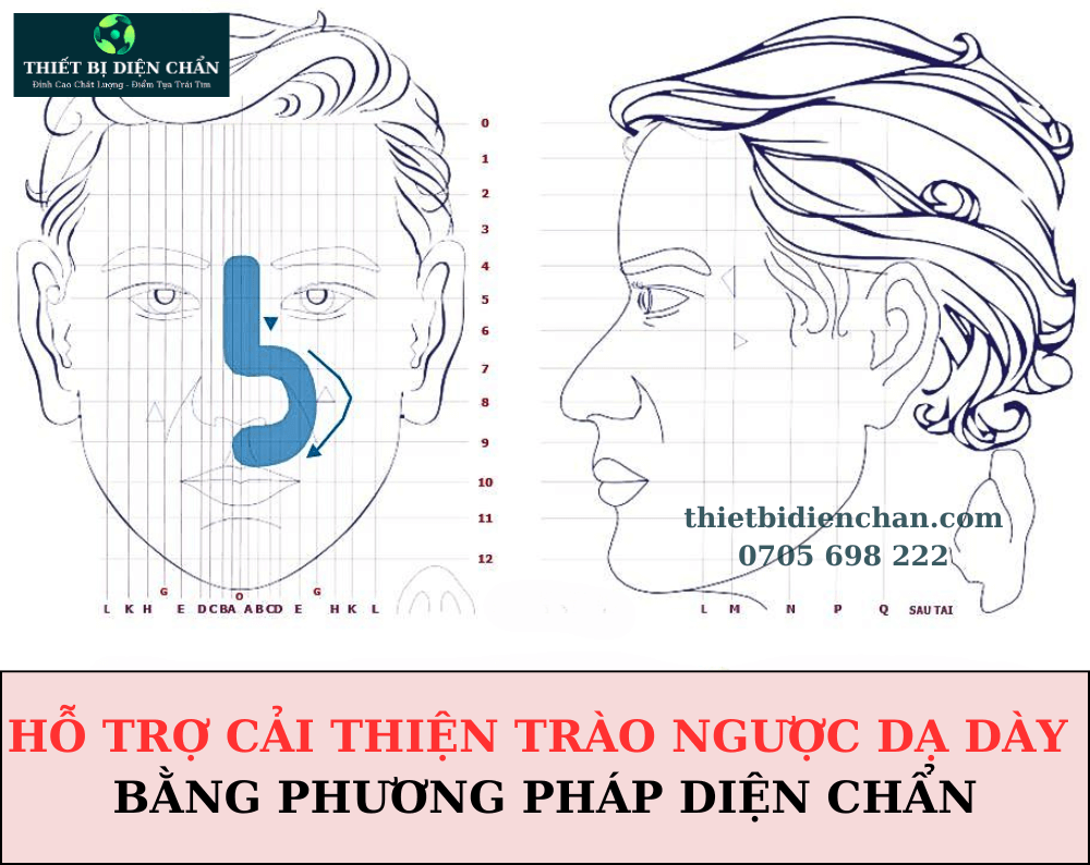 Trào ngược dạ dày