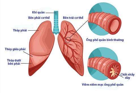 Viêm phế quản